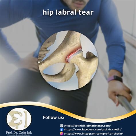 labral tear diagnosis